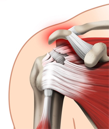 Les-tendons-de-la-coiffe