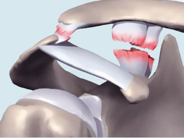 La pathologie de l’articulation acromio claviculaire