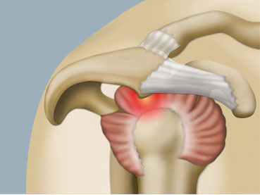 Le conflit sous acromial de l’épaule