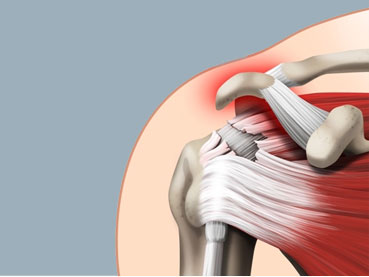 Les calcifications des tendons de l’epaule