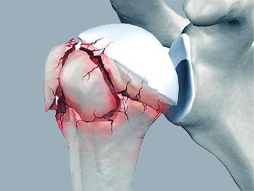 Les fractures de l’épaule