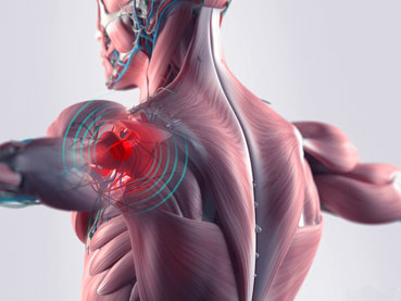 Rupture des tendons de la coiffe des rotateurs