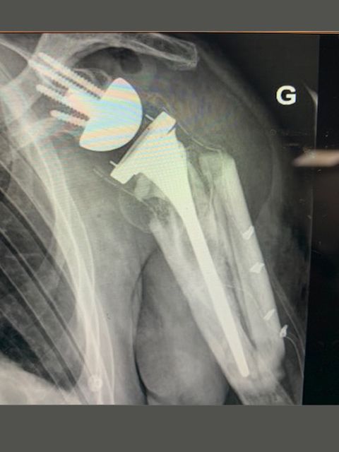 Scanner-fracture-epaule-sous-prothese-epaule